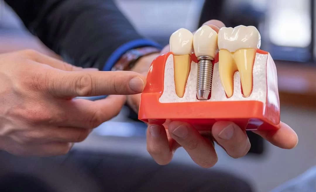 Dentsply İmplant Markası İyi mi? Fiyatı Ne Kadar?