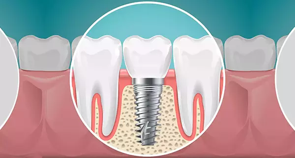 Bakırköy İmplant Fiyatları, Diş İmplantı Pahalı mı?