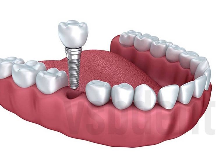 Silivri İmplant Fiyatları, Diş İmplantı Pahalı mı?